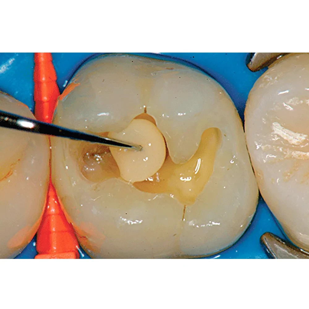 Prime Dental Restorite Micro Hybrid Kit Restorite micro-hybrid composite kit