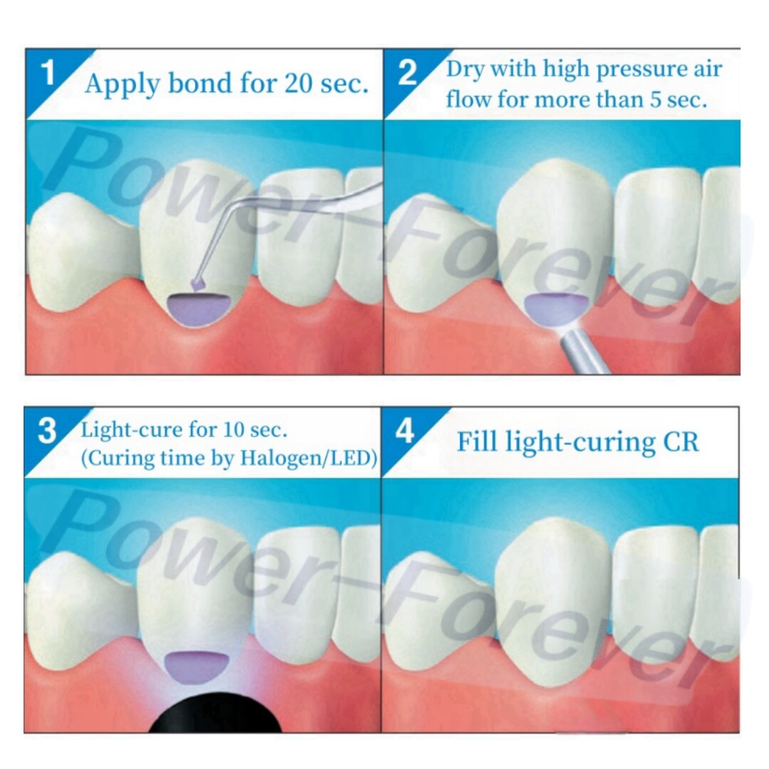 Kuraray Dental ClearFIL S3 BOND light-curing Self-etching Primer Bond Adhesive