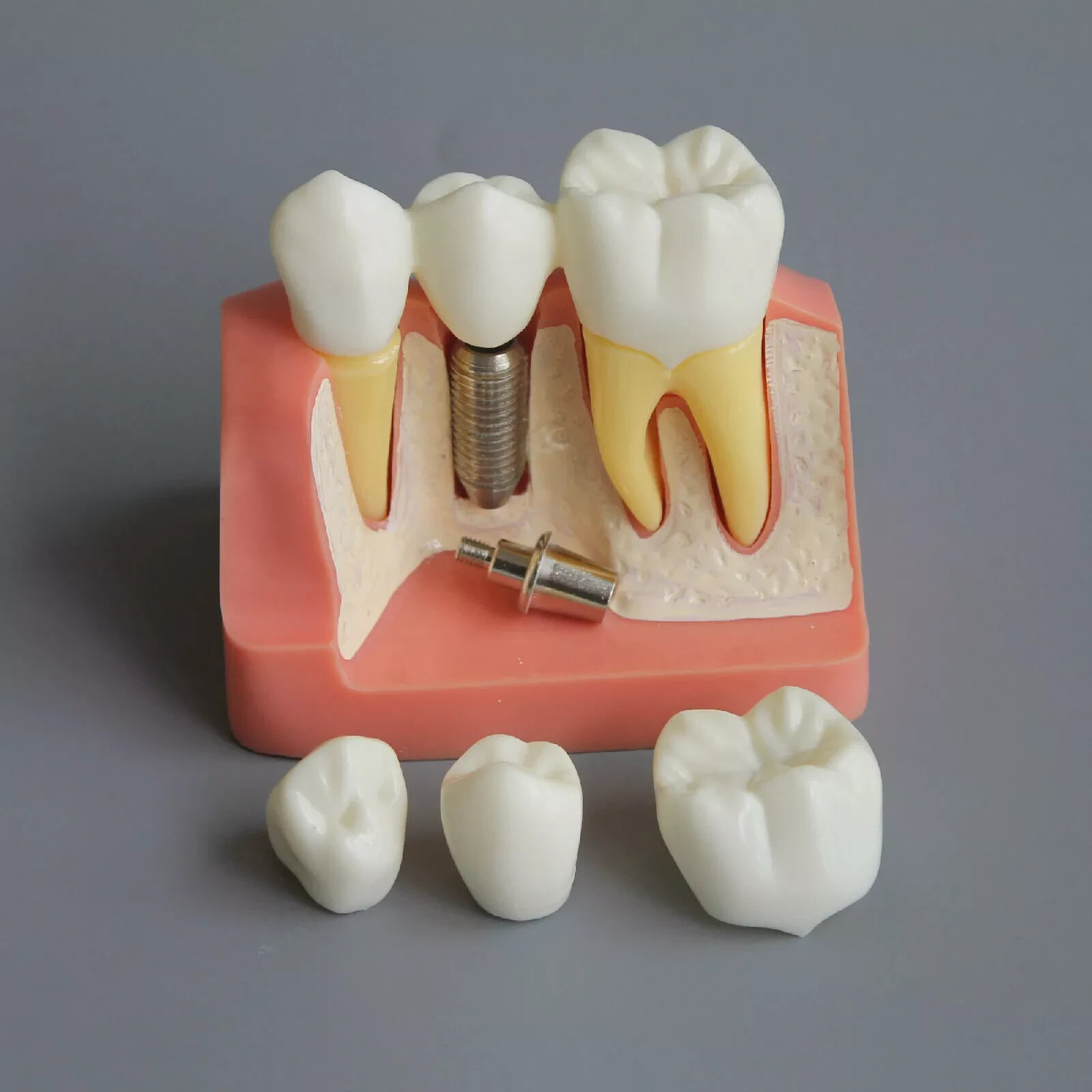 2Pc Dental Oral Analysis Crown Bridge Demonstration Tooth 4 Times Model Typodont