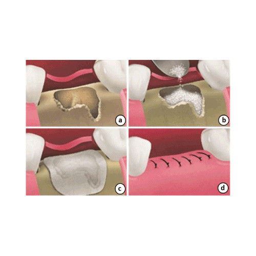 DSI Dental Fixture Titanium Reinforced Membrane PTFE 20x25mm