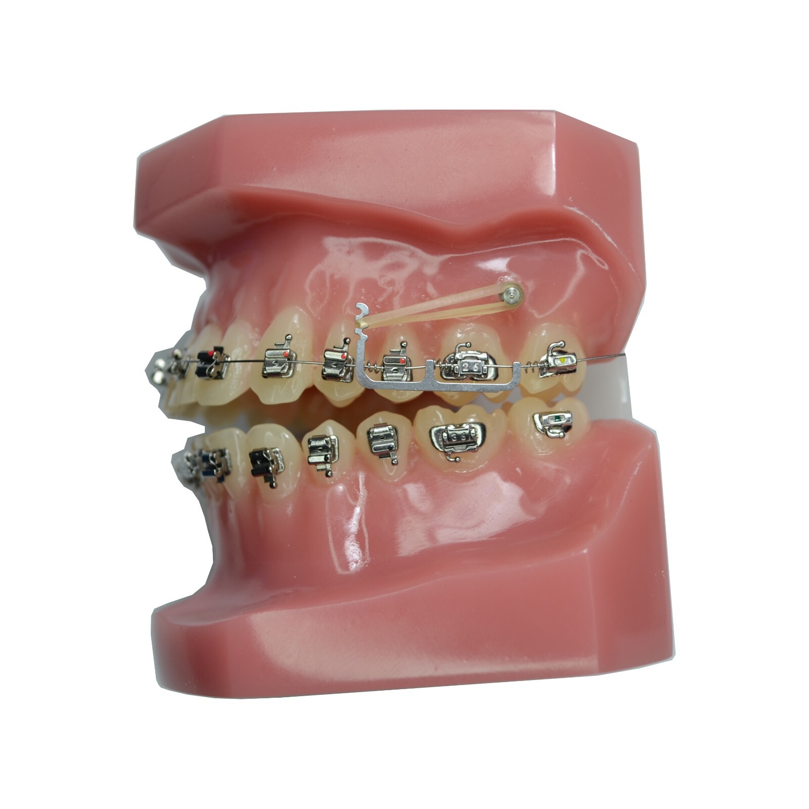 J&J™ Orthodontic T-Pull Molar Distalizing Motion Appliance (2/pk)