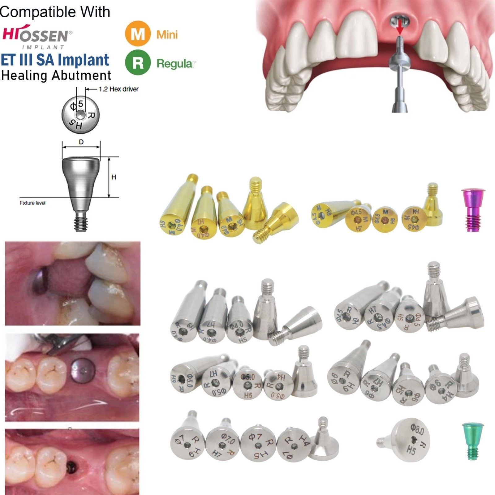 Fit Hiossen Locator/Healing Cap/Transfer lmpression Coping Open/Closed Abutment