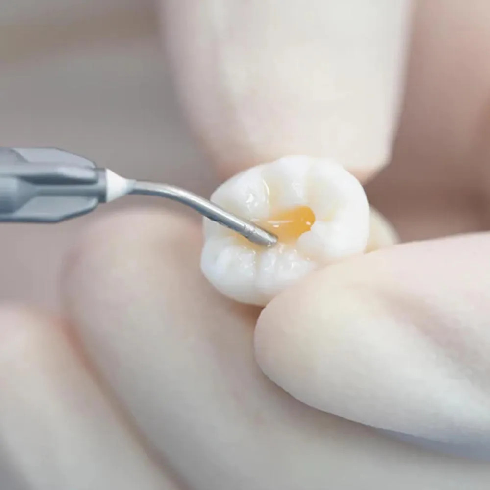 Vincismile Trusfil-flow Flowable Composite