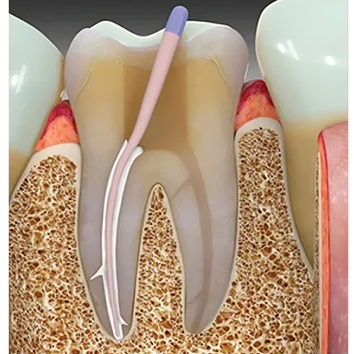 DiaDent Dia-Proseal Resin-Based Root Canal Sealing Material High Radiopacity