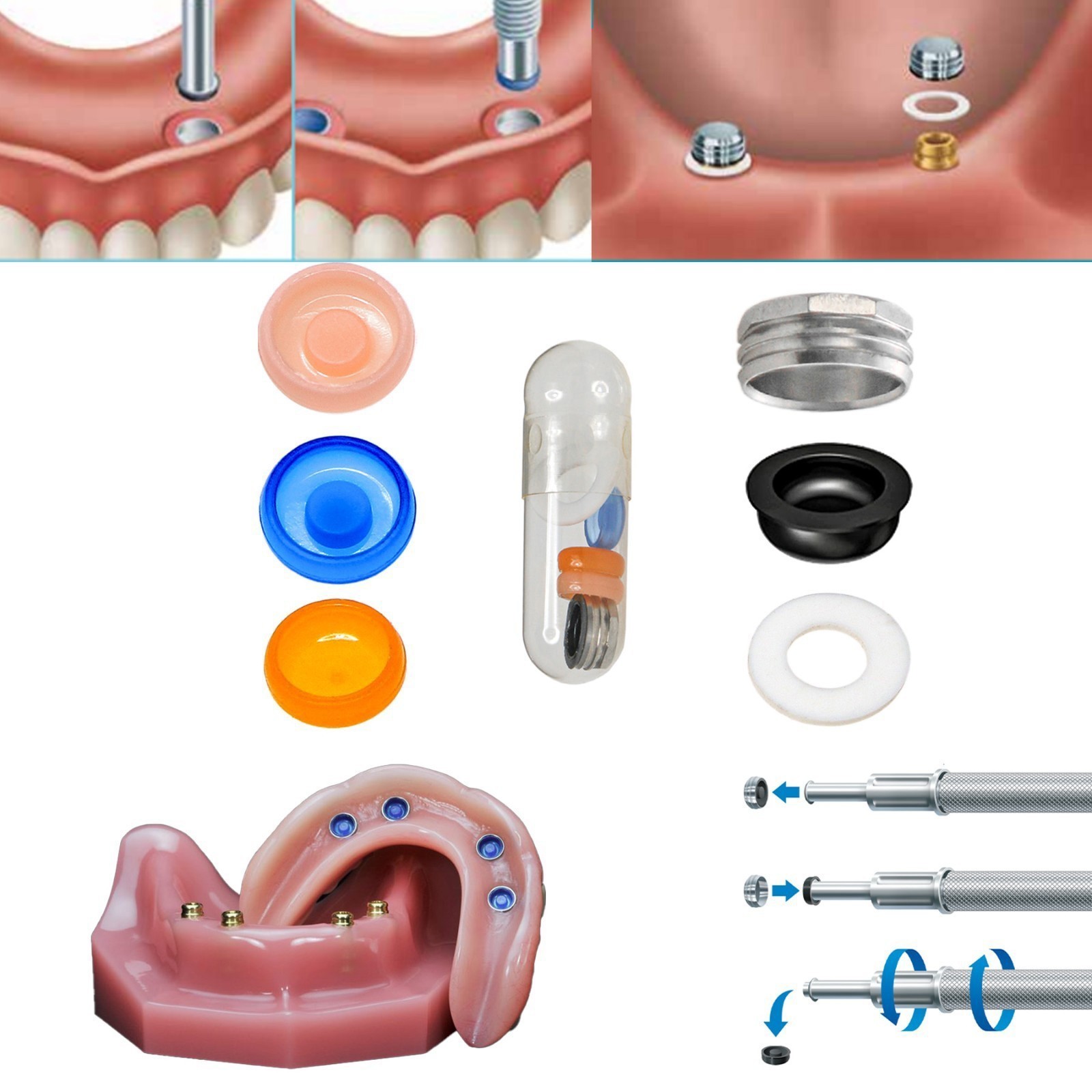 20Pcs Dental Overdenture Locator Implant Abutment Retention Cap Inserts Set