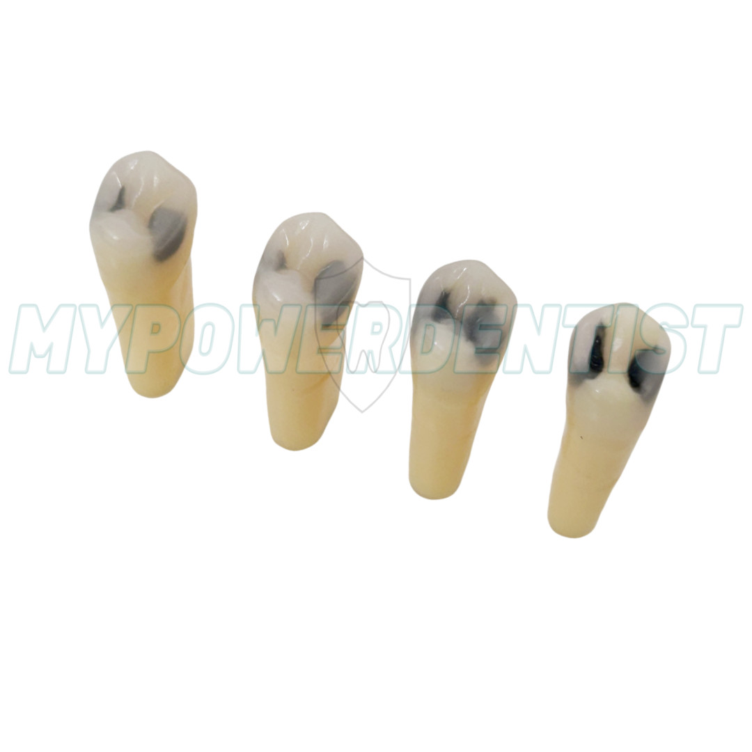 Dental Cavity Teeth Model Tooth Teaching Caries 25# Compatible Frasaco AG-3