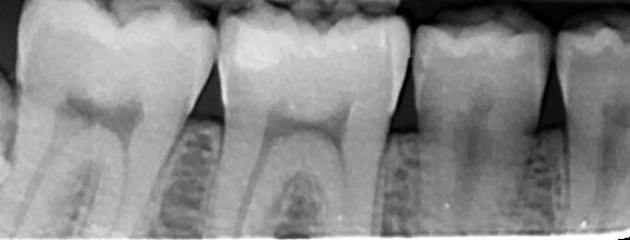 Dental Teeth X-Ray Model Practice Exam Simulator Training Phantom 32 Teeth