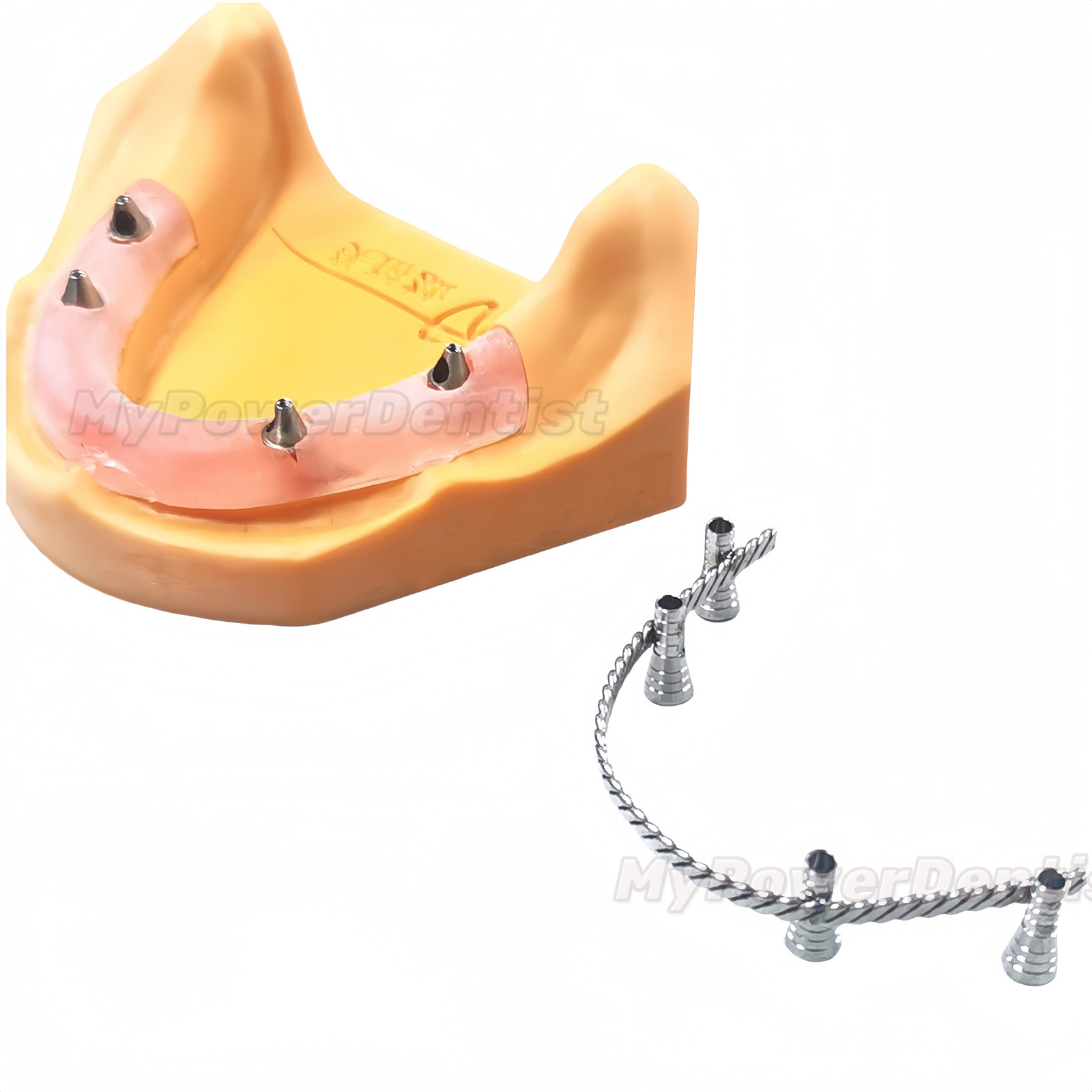 Dental Twist Strengthener Wires for Im plant 4 inch Length Similar Bredent