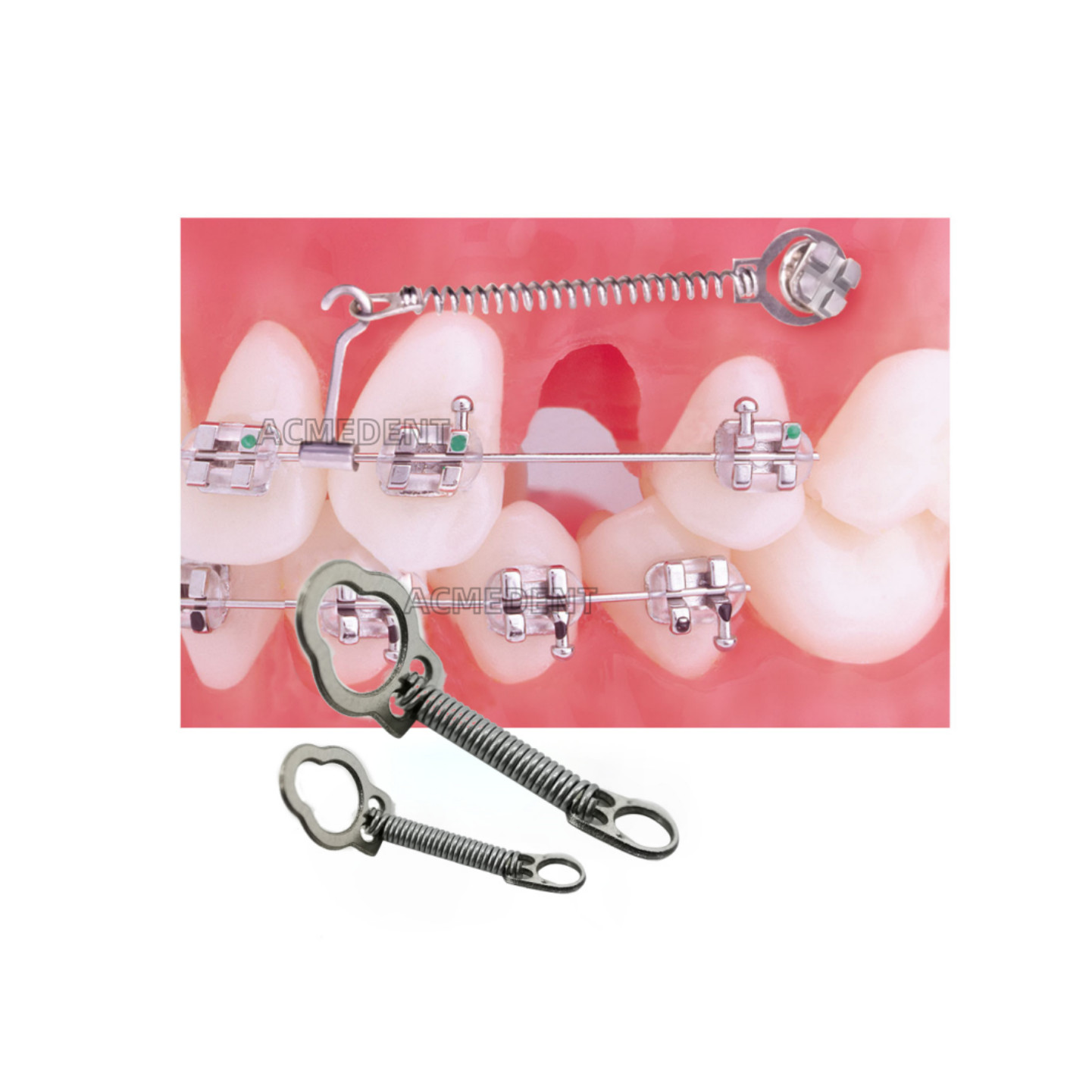 Dental Coil Springs NiTi Closed Spring Mini Screws Micro Anchorage Implant TAS