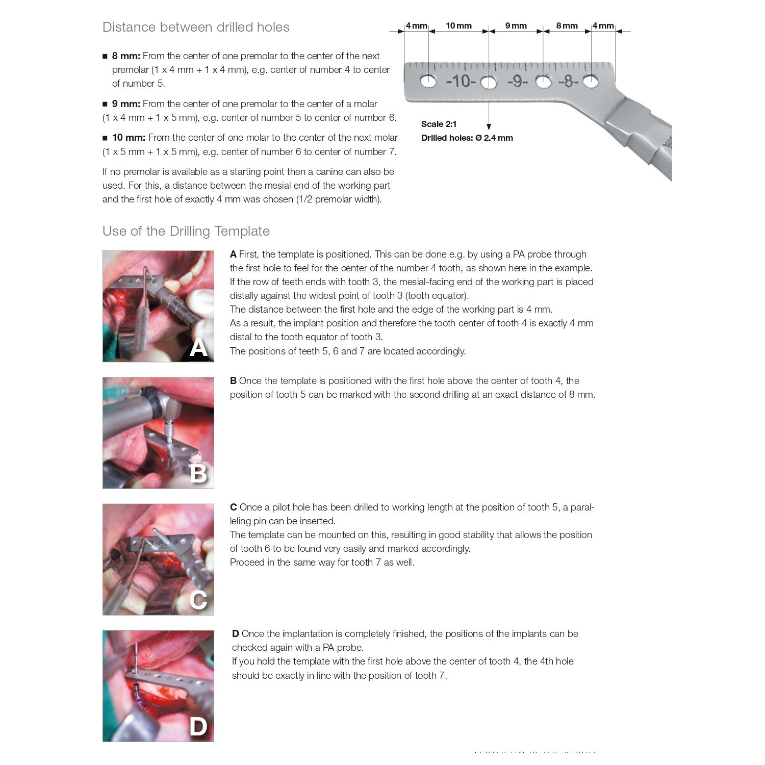 Dental Surgical Drilling Template for Accurate Guide Implant Positions Posterior