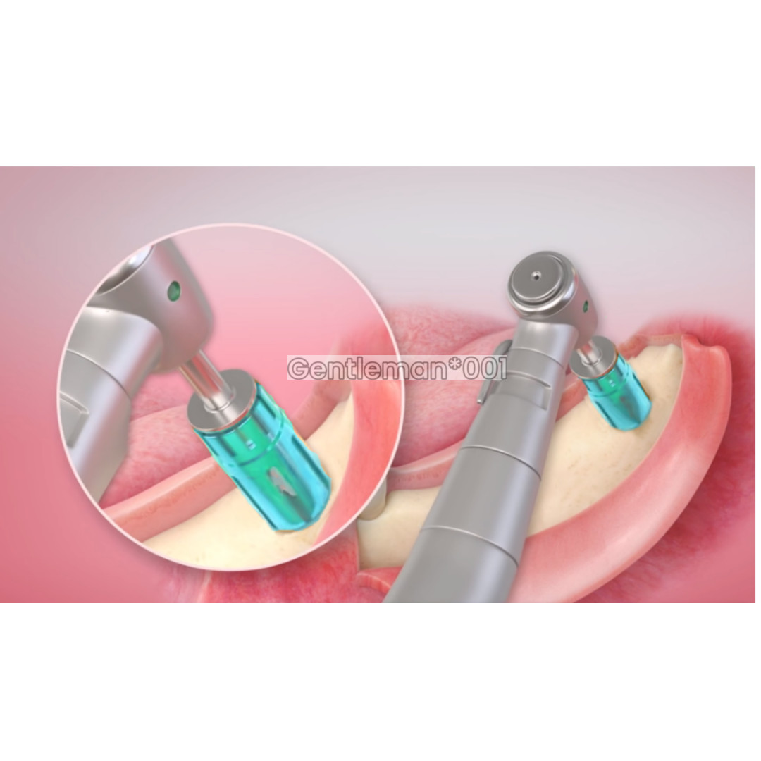 Dental Autobone Chip Autologous Bone Harvesting Drill Never Loss Harvest Implant