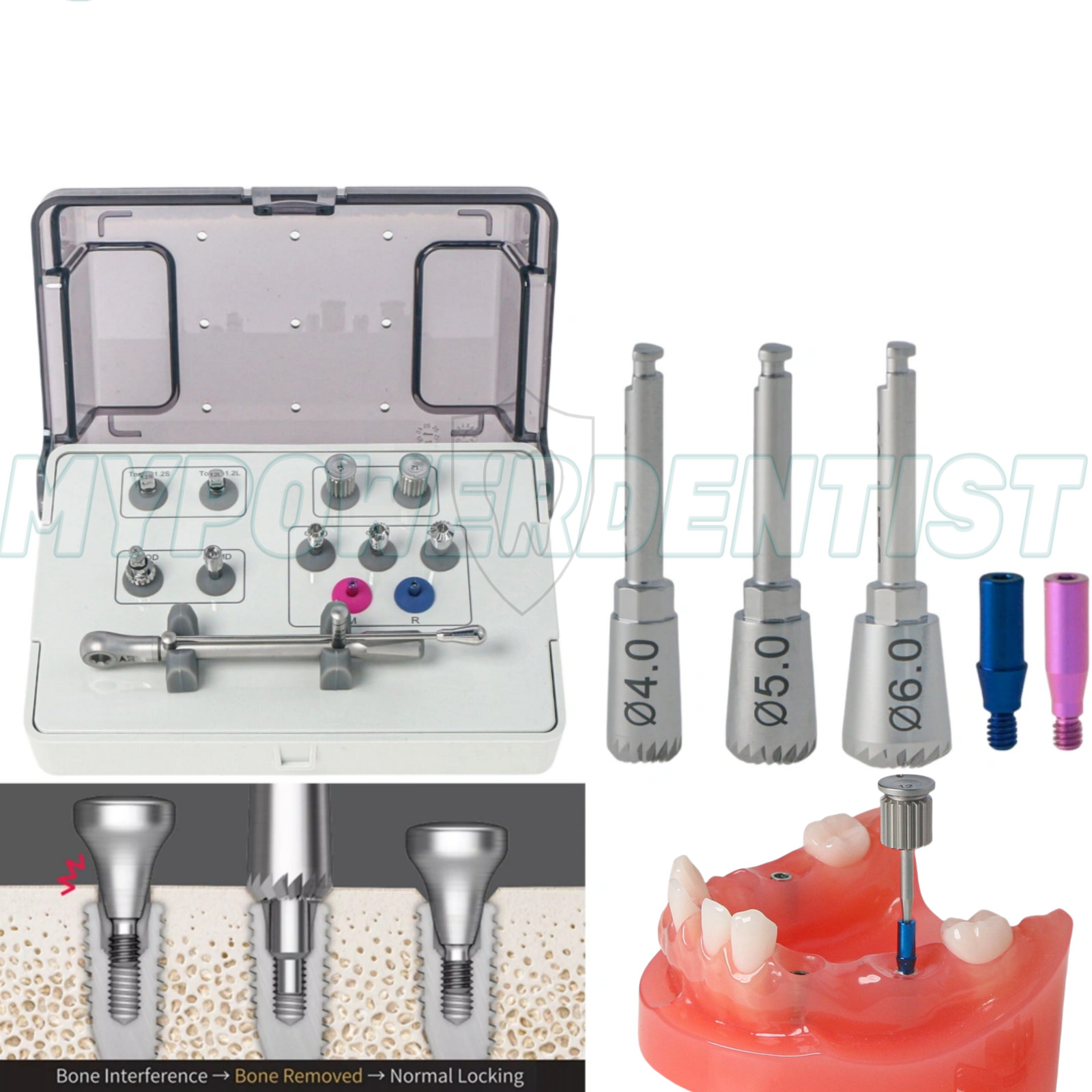 Im-plant Prosthetic Kit Torque Driver Multi ABT Bone Profiler M6019 4.0/5.0/6.0