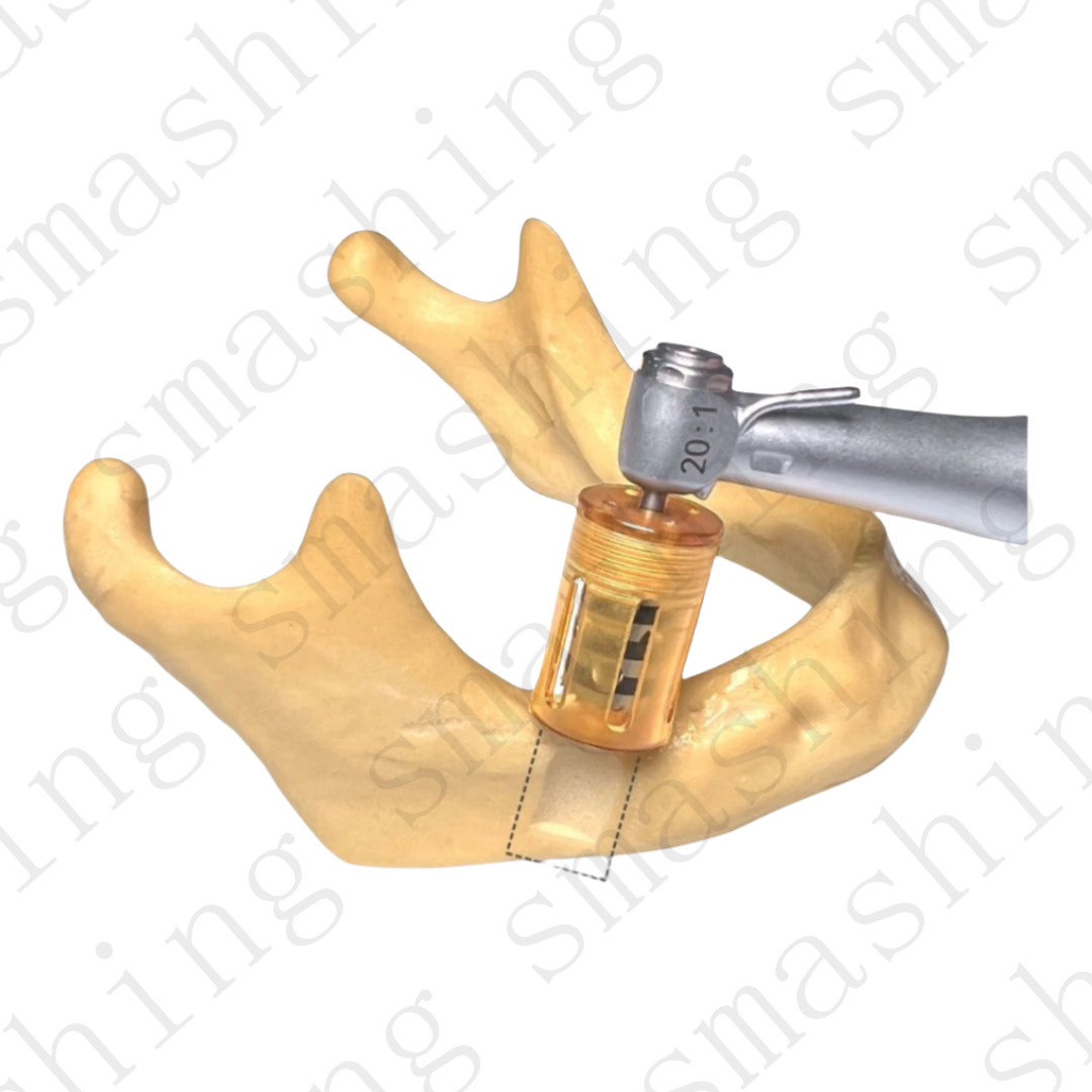 Dental Bone Slice Collector Drill Harvest Half Month Sheet-like Drilling SLT GBR