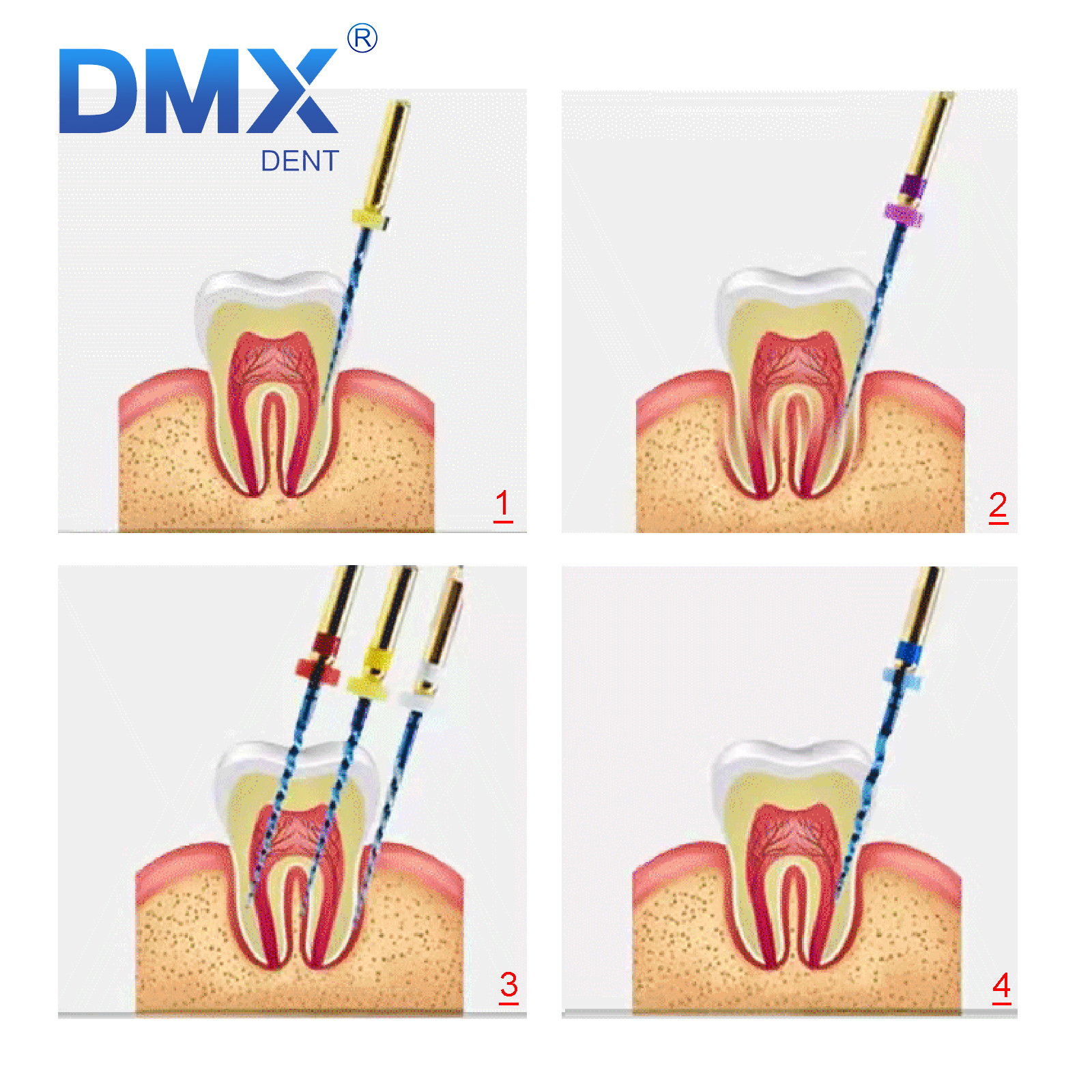 DMXDENT Dental Endo PT-Blue Root Canal Endodontic Niti Rotary Files 21/25/31MM