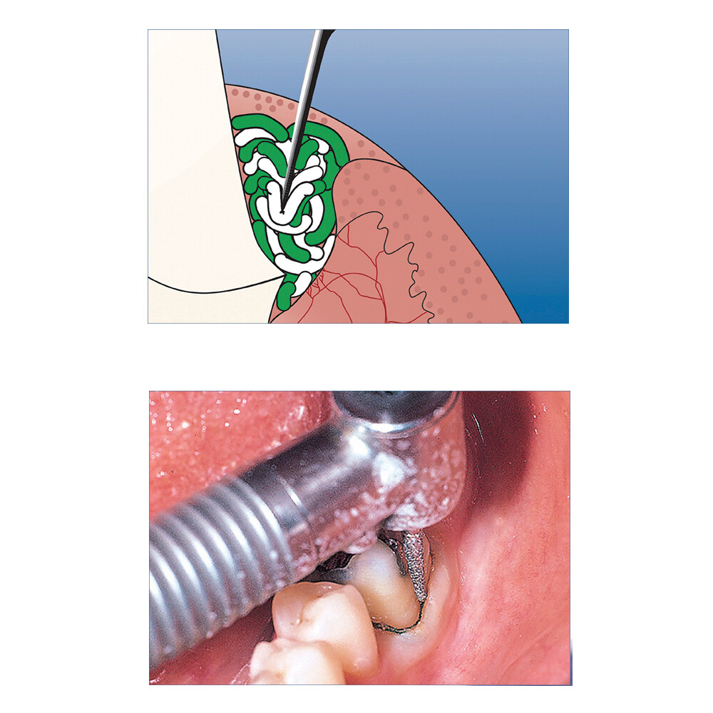 3 Types Dental Gingival Retraction DS-CORD Set Twist Impregnated Size Select