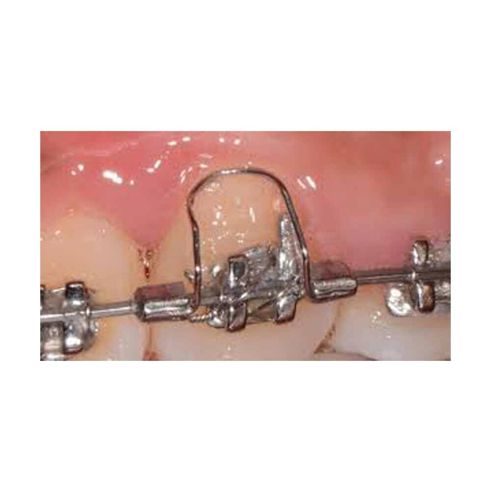 J&J Ortho™ Dental Orthodontic Archway Torquing Arch Spring (10/pk)