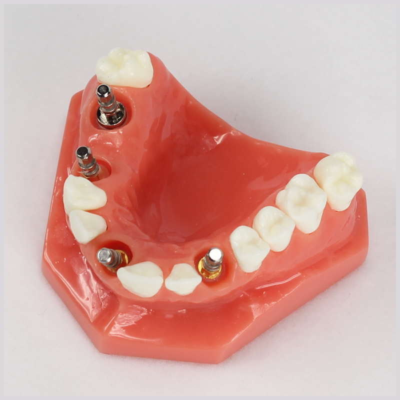 Dental Upper Jaw Implant Model (Red) with 5 implant #2012 01