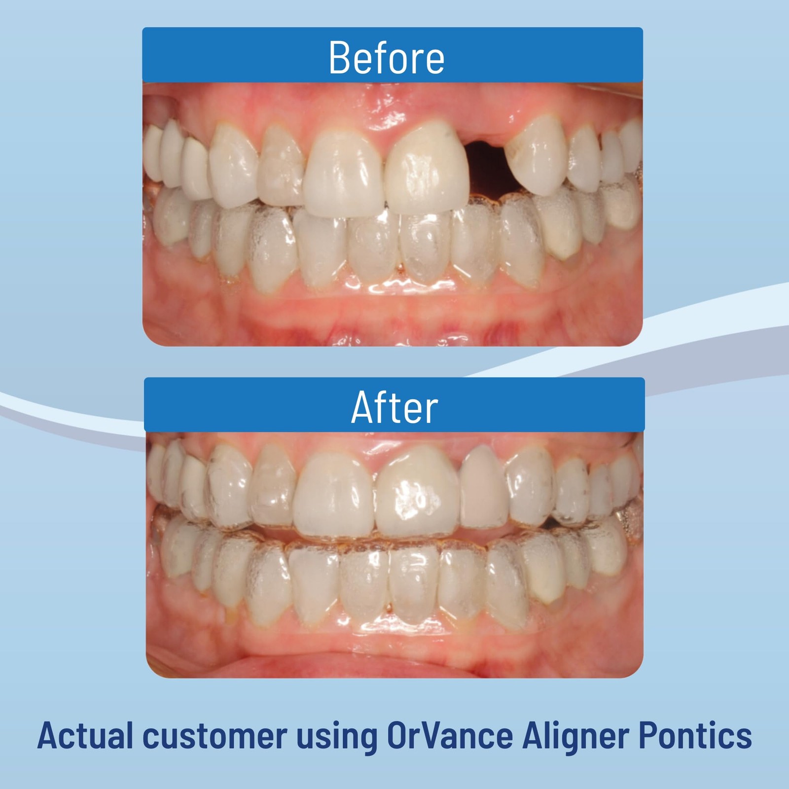 OrVance Aligner Pontics – Original 16 Count (Pack of 2), Medium Shade