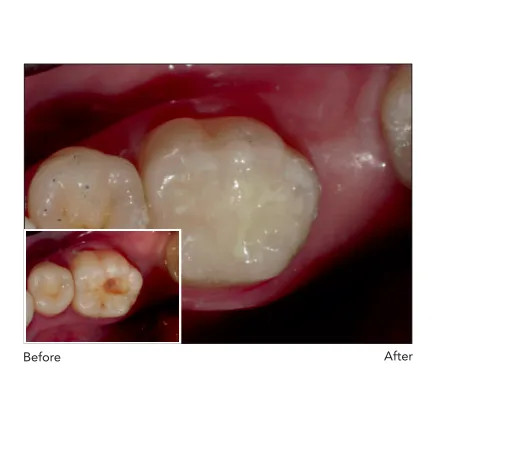 GC Gold Label Advanced Hybrid Technology Bulkfill High Strength Glass Ionomer.