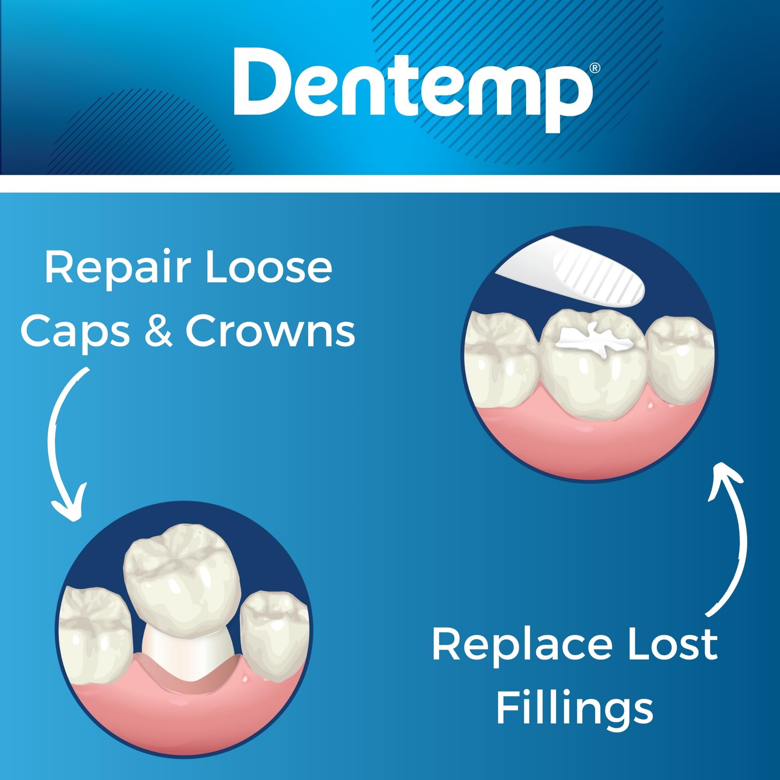 Dentemp Loose Cap and Lost Filling Repair Kit Pack of 3 Dental Repair 80 Uses