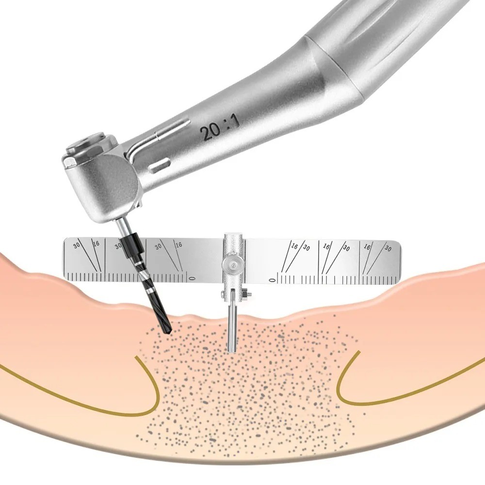 Dental Implant Locating Guide Surgical Planting Positioning Locator Angle Ruler