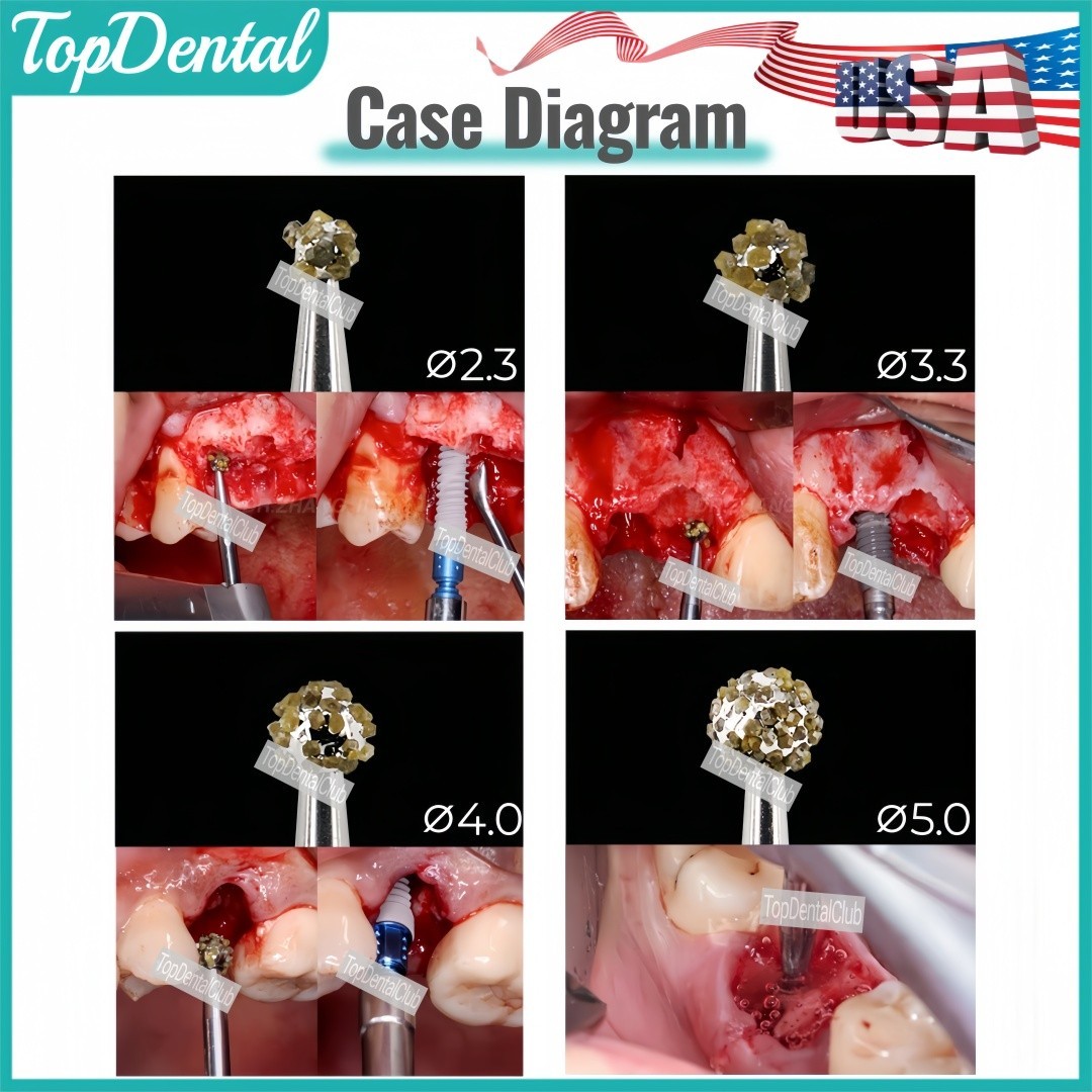USA Dental Degranulation Burs Kit Bone Debridement Remove Soft Tissue Remnants