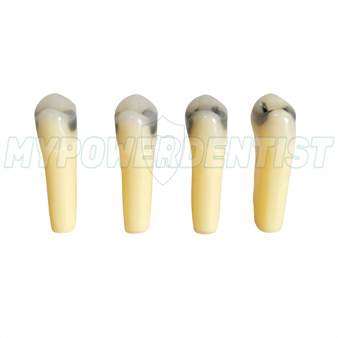 Dental Cavity Teeth Model Tooth Teaching Caries 25# Compatible Frasaco AG-3