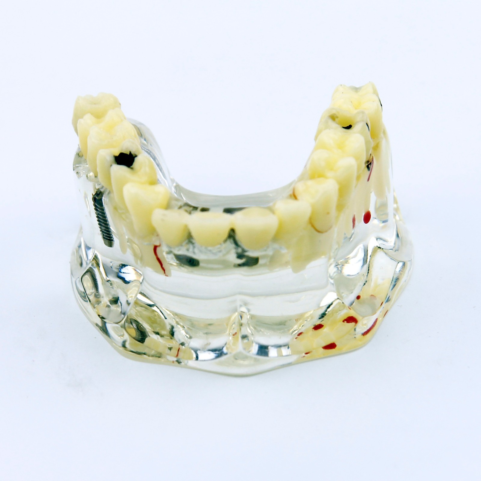 Dental Upper Jaw Implant Model with Bridge and Caries -I 2006