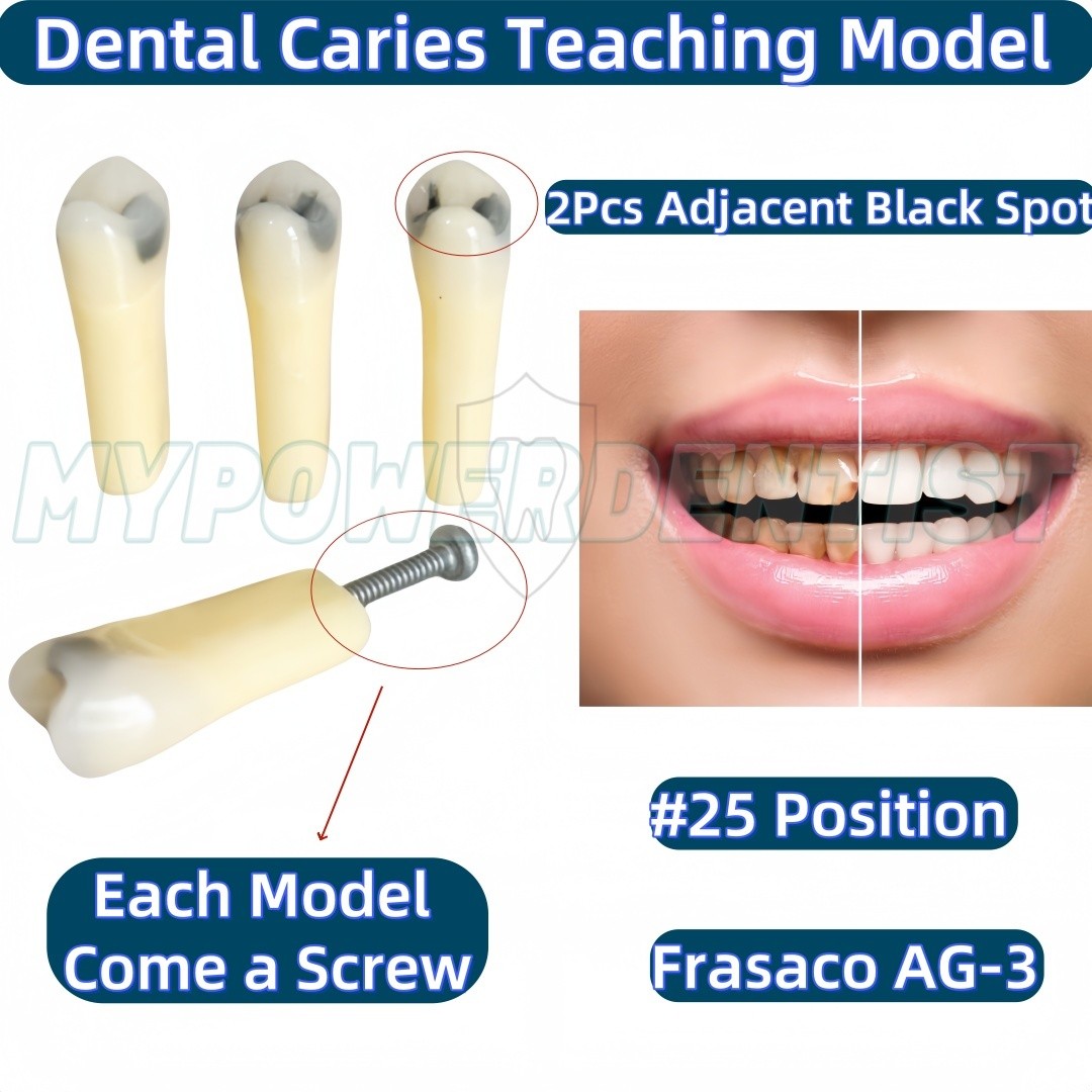 Dental Cavity Teeth Model Tooth Teaching Caries 25# Compatible Frasaco AG-3