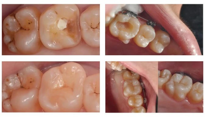 C14 Emax CAD/CAM All-Ceramic Dental Glass Without Sintering Cerec Block 5PCS/BOX