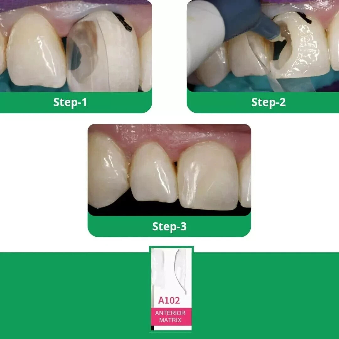 BioClear Anterior Kit Modern Matrix System for Esthetic Restorations Fresh Stock