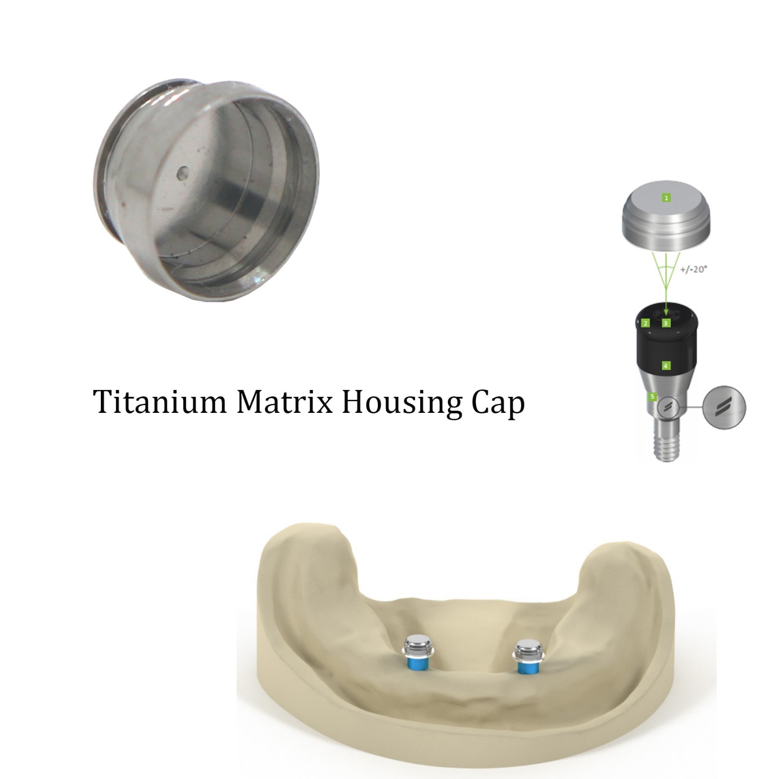 US Dental Locator Overdenture Male Caps Novaloc Retention Inserts Cap Core Tool