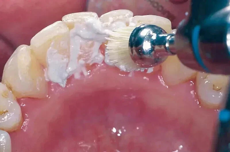 Dental SPECTRA Prophylaxis Polishing Paste After Scaling 200gm Jar MINT