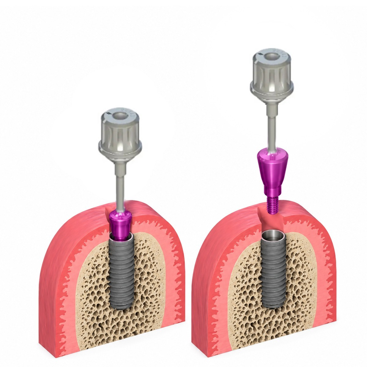 US RC Healing Abutment & Closure Cap Fit Straumann Bone Level Regular Titanium