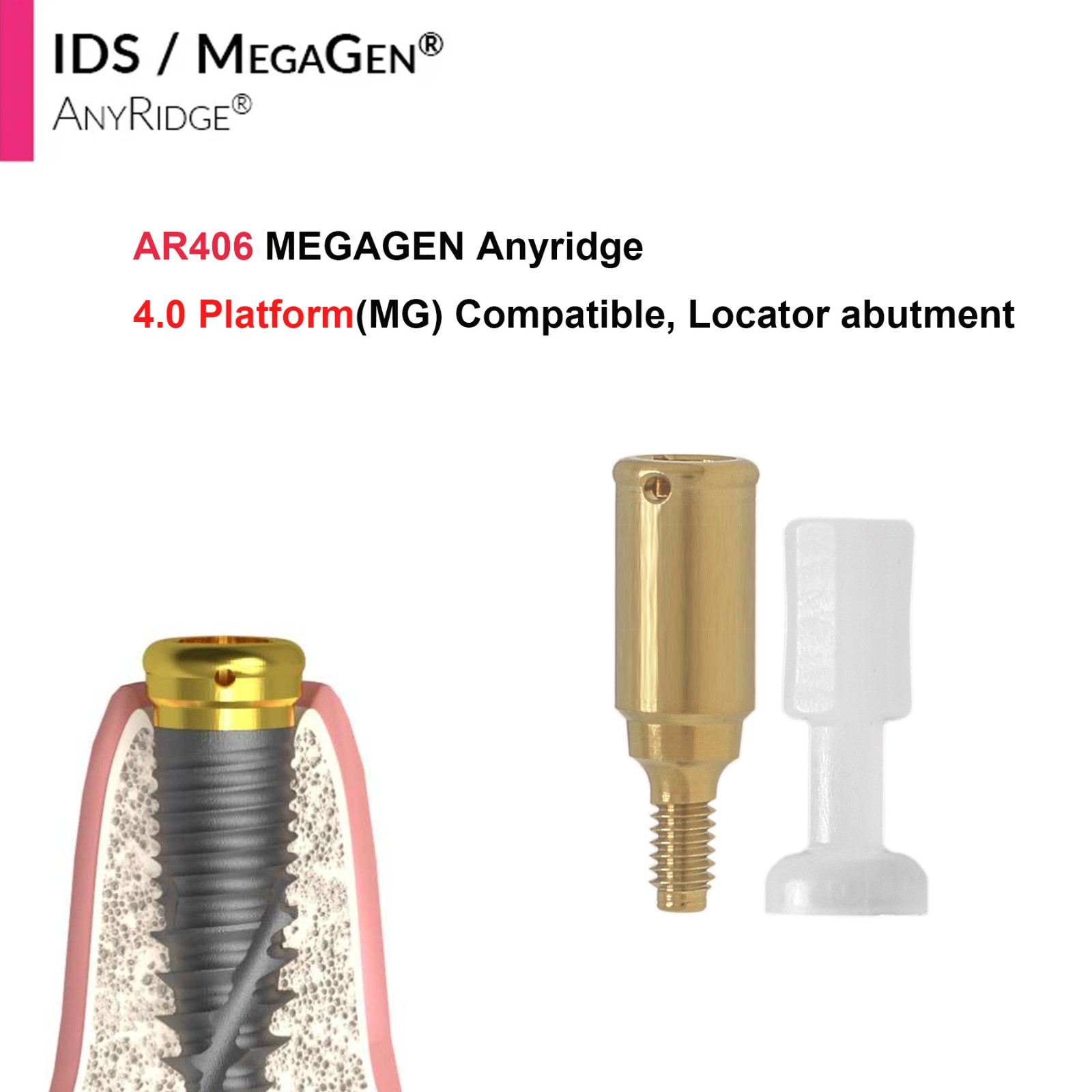 Implant Fit Zest Locator Abutment Hiossen/Nobel/Zimmer/GM/MegaGen /Straumann