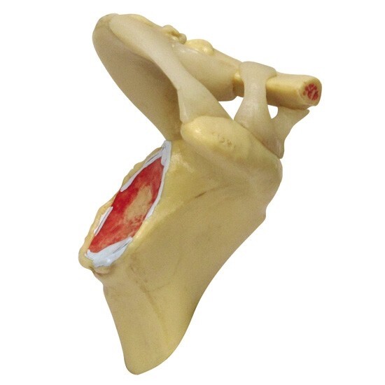 GPI Anatomical – #1800 4-Stage Osteoarthritis Shoulder Anatomy Model