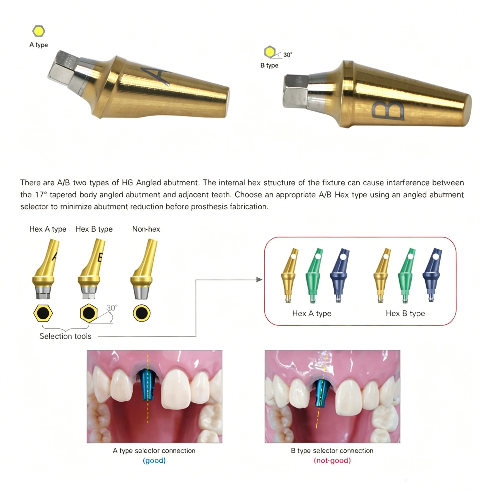 US Dental Prosthetics Angled 17°/Straight Titanium Abutment fit Hiossen ET OSS