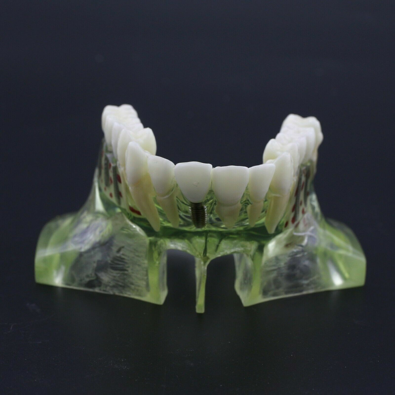 Dentist Student Tool Dental Model Upper Jaw With Crown Bridge