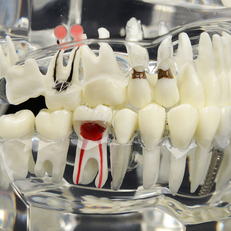 Dental Disease Model Teeth Teach Study Oral Teeth Bridge Restoration Pathology