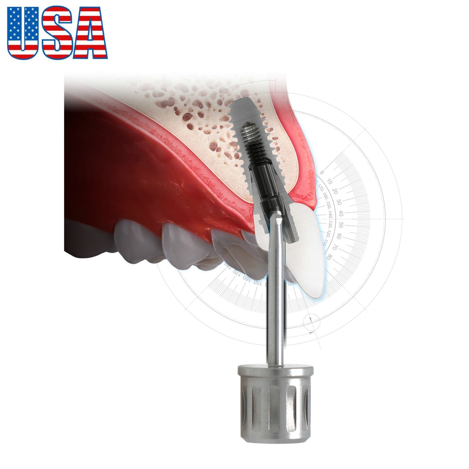 US Implant Screwdriver Angulated Screw Channel Driver Hiossen Nobel MIS Astra 3i