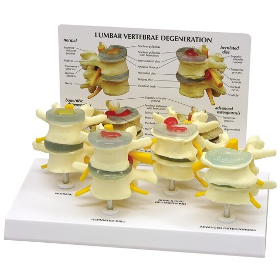 GPI Anatomical #1760 4-Stage Vertebrae Osteoporosis Model Herniated Disc