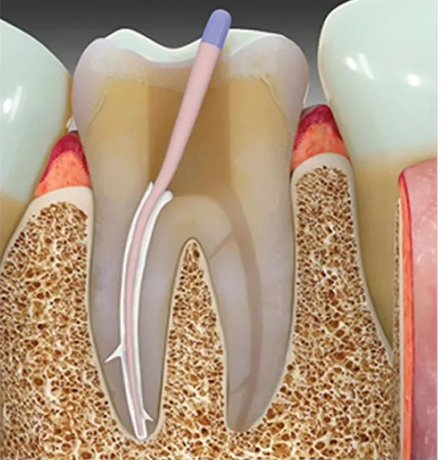 Sybron Endo Sealapex Root Canal Sealer