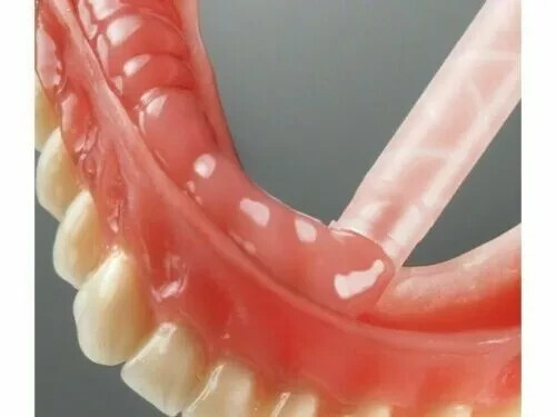 MOLLOSIL Long Term A Silicone based Denture Reline Material CHAIRSIDE USE