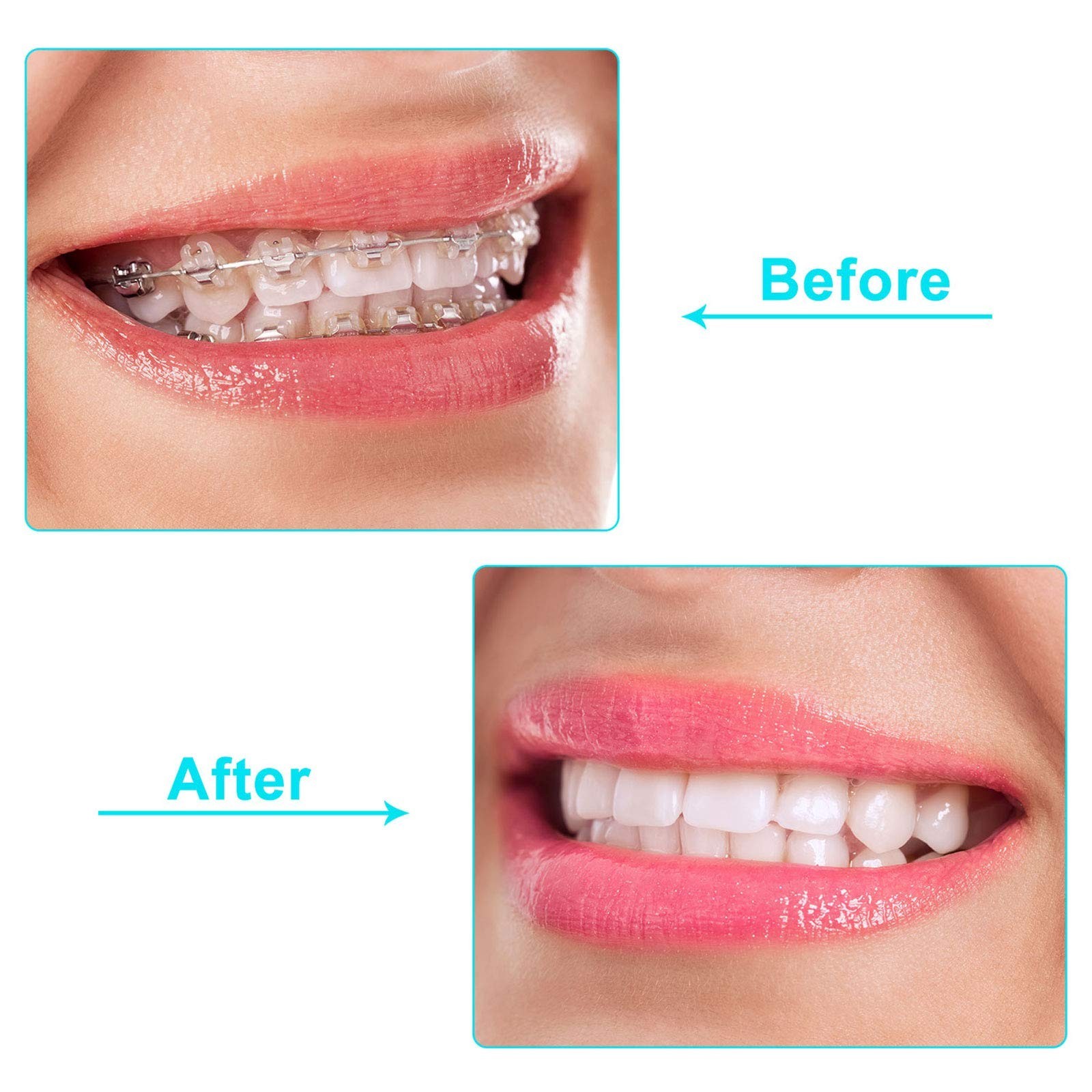 100 Pieces Orthodontic Aligner Trays & Chompers – White, Green, Orange, Pink, Pu