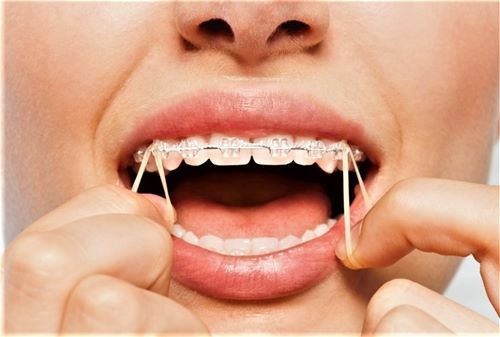 Orthodontic Elastics, 100 Elastics per Bag, 50 Bags per Box, Modern Arch