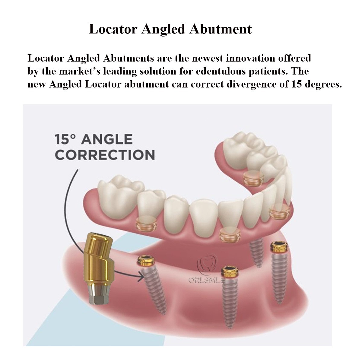 15° Angled Overdenture Abutment fit to Osstem TS Regular GH1.5-4.5mm