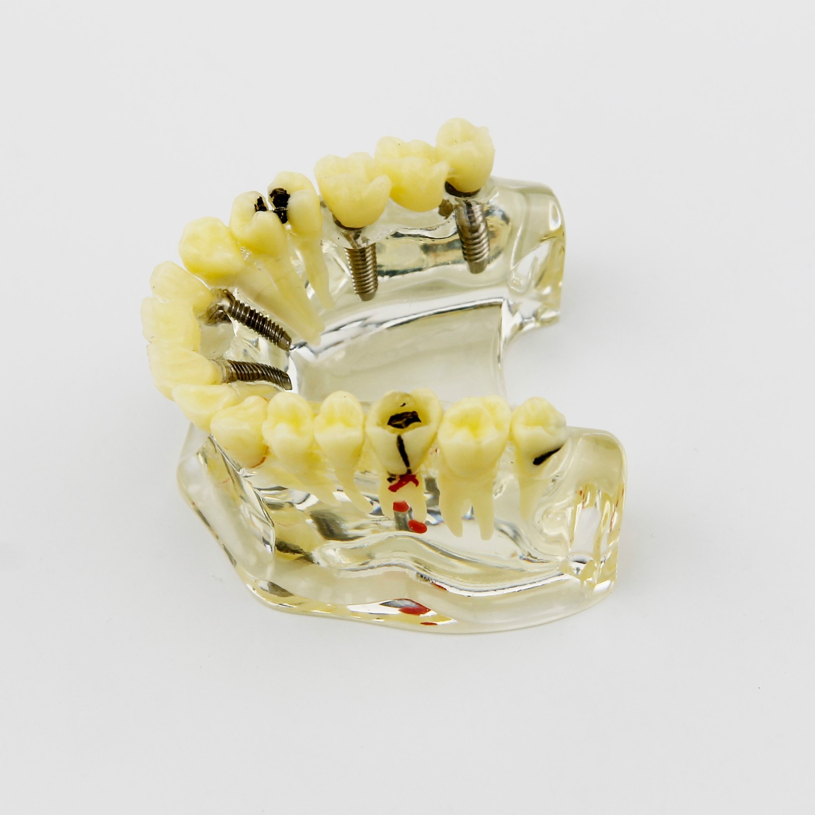 Dental Upper Jaw Implant Model with Bridge and Caries -I 2006