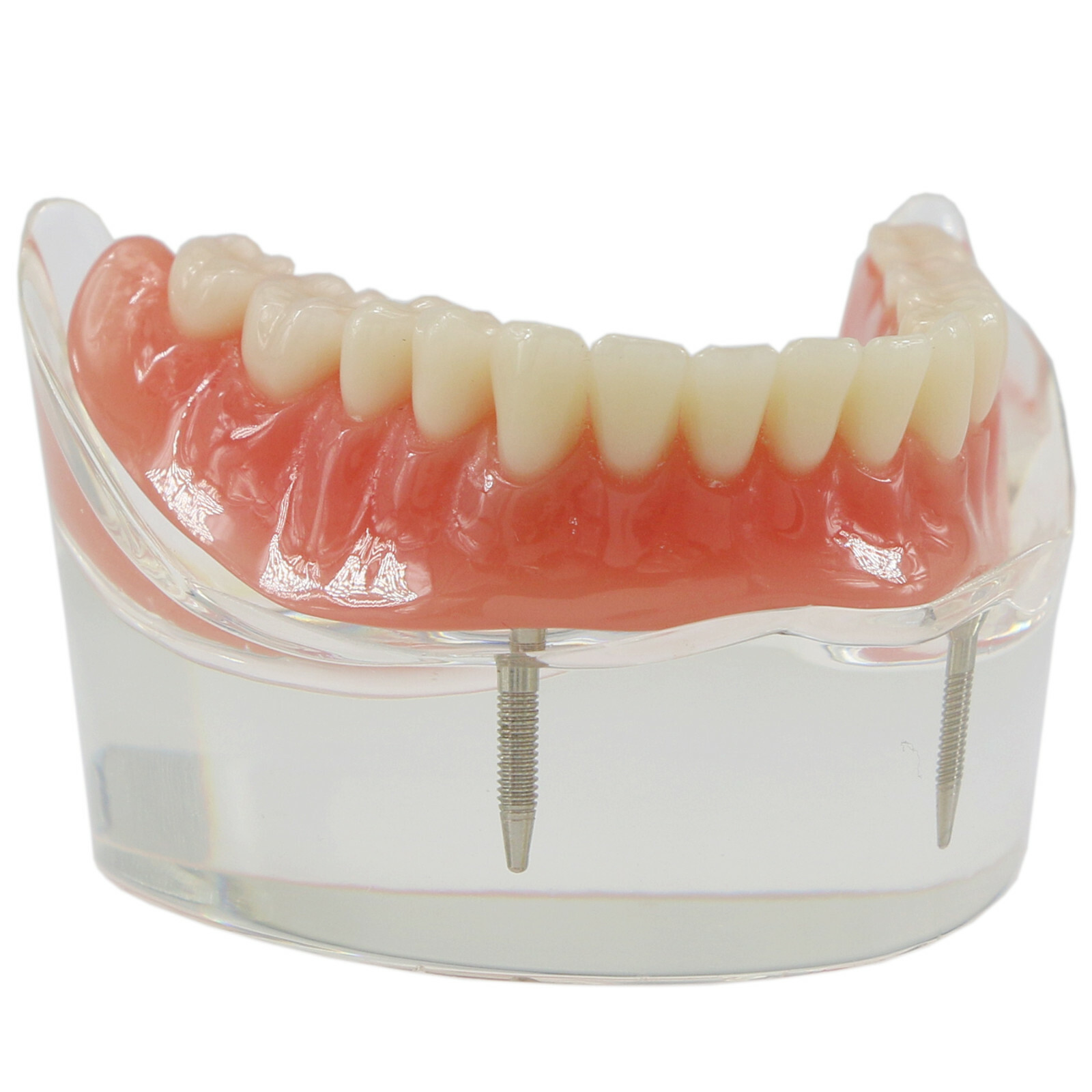 Dental Typodont Teeth Model Overdenture Lower Inferior 2 Implants Demo M-6002 US