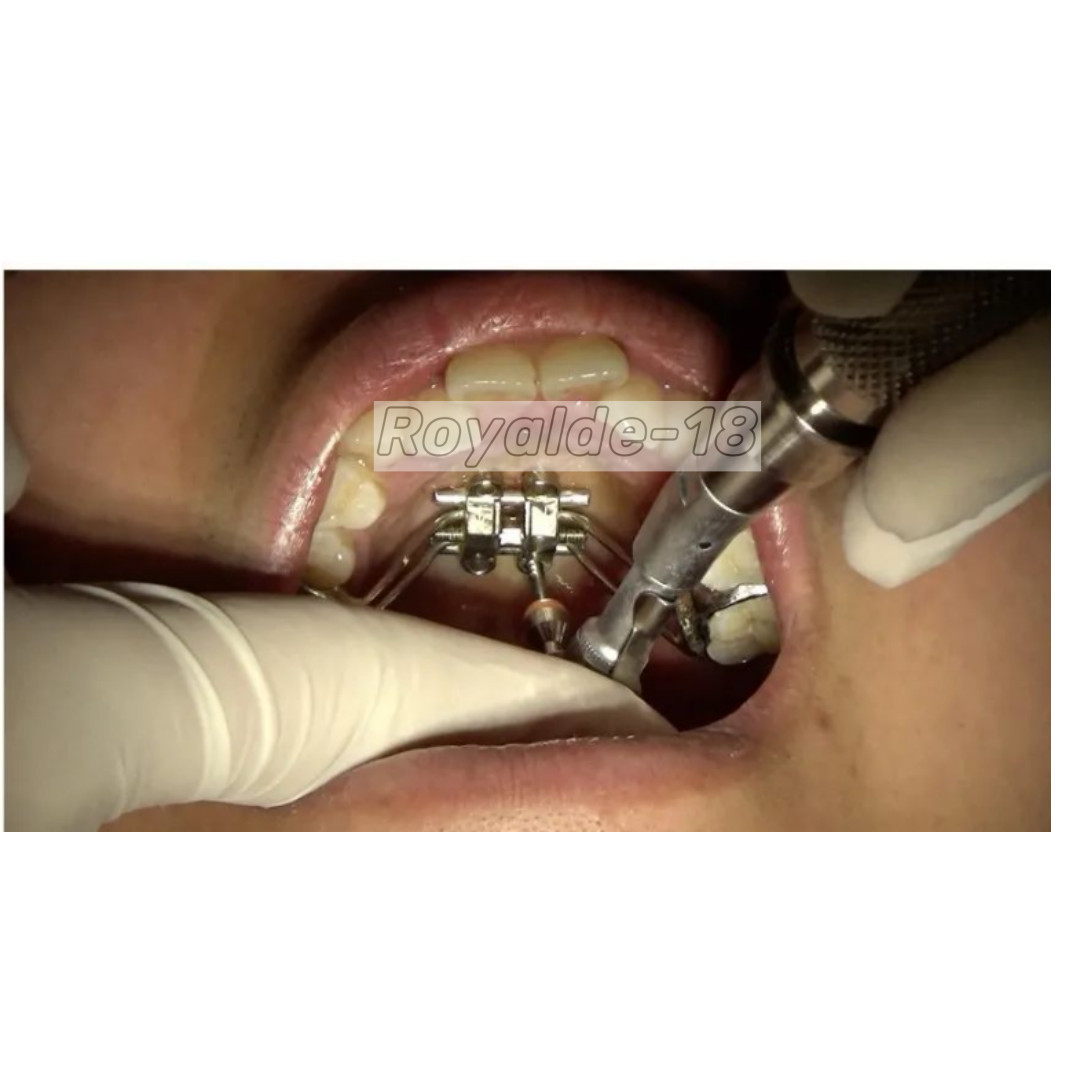 MSE Dental Palatal Expander Orthopaedic Mid Facial Parallel Expansion Screw Rod