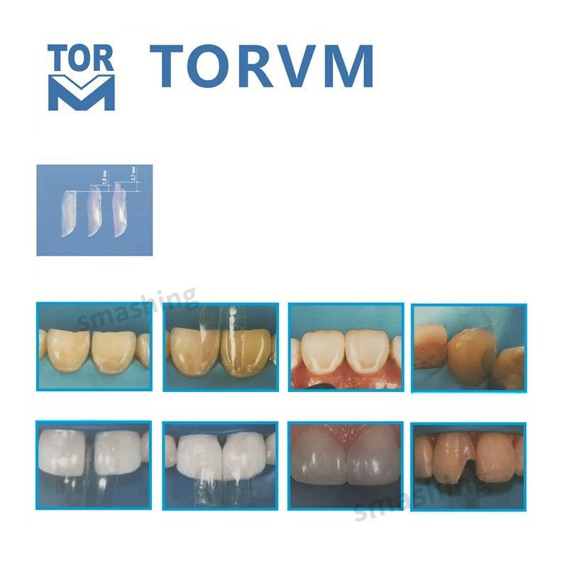 Dental Clear Matrix Anterior Matrices Bow BT Fits Bioclear L/M/S Matrice TOR VM